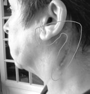 Lipome, cicatrice sans fils de sutures (Silviane Le Menn)